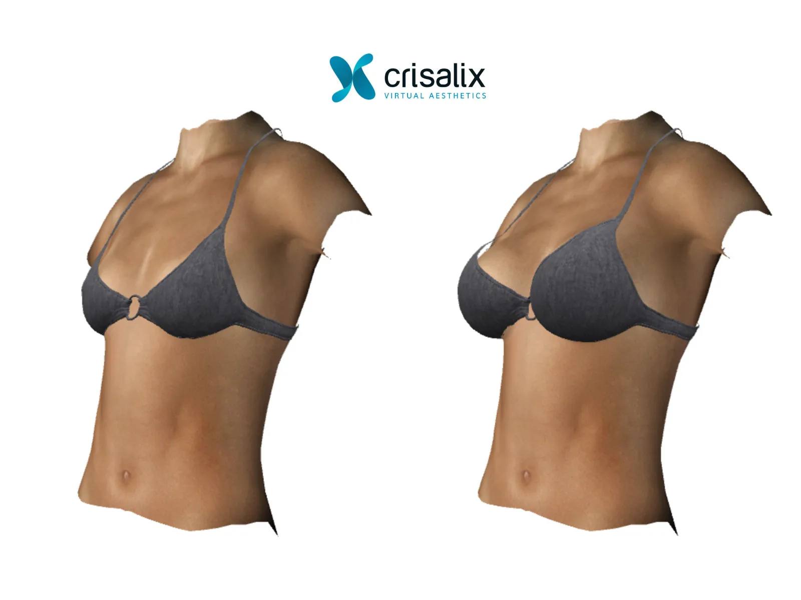 3D before / after breast simulation, with a swimsuit